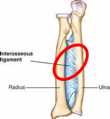 Diagram of the forearm bones, radius and ulna, with the interosseous ligament between them circled