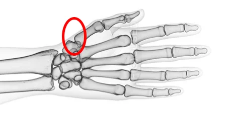 Skeleton of the hand with the base of the thumb, where it meets the wrist, circled