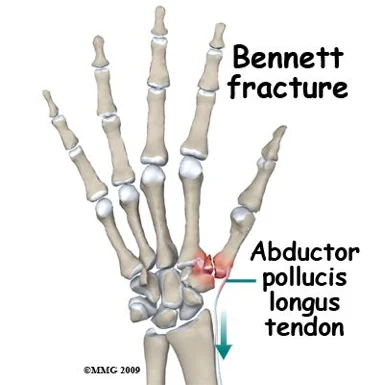 Hand skeleton diagram of a Bennett fracture at the base of the thumb, with the abductor pollicis longus tendon pulling