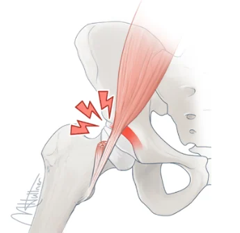 Illustration of the front of the hip showing a tight hip flexor tendon snapping over the hip joint, marked with red jolts