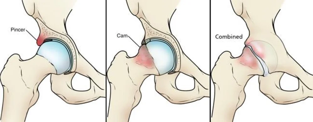 Diagrams of three types of hip impingement: pincer (extra bone on the socket), cam (bump on the femoral neck) and combined