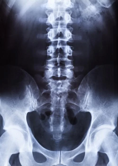 Front-on X-ray of the lower spine and pelvis