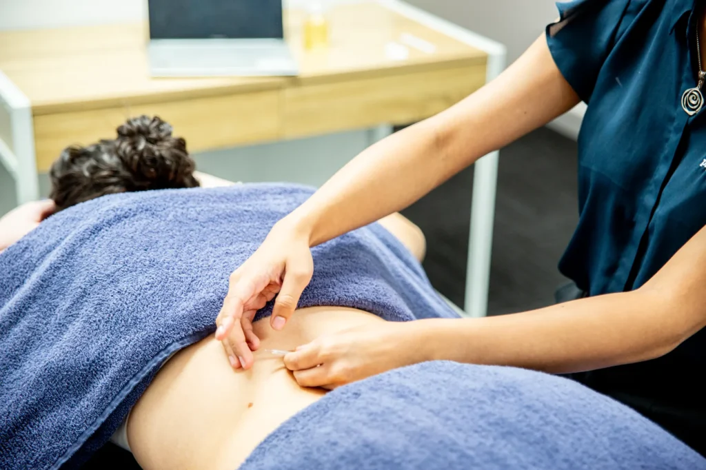 A physiotherapist performing dry needling on a patient’s back