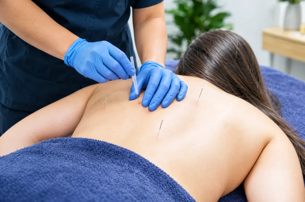 A massage therapist in gloves placing a fine dry needle in a patient’s upper back during a remedial massage